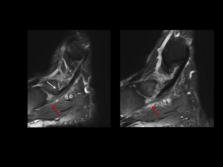 Figure 5 for case posterior tibial tendon ( RID3194 )